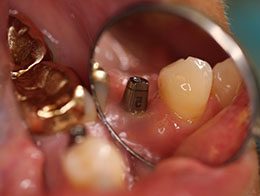Dental Impant: before