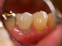 Dental Impant: after
