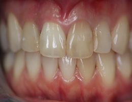 teeth discoloration repair: before