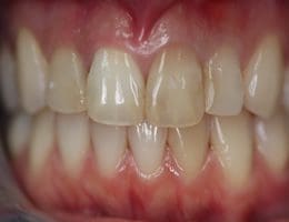 teeth discoloration repair: before