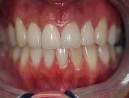 teeth discoloration repair: after