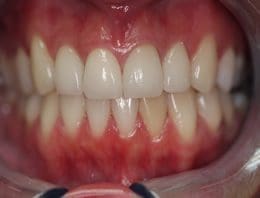 teeth discoloration repair: after