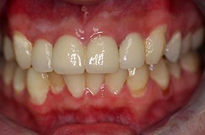 Anterior Crowns Custom Shade Matching: after