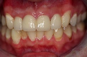 Anterior Crowns Custom Shade Matching: after