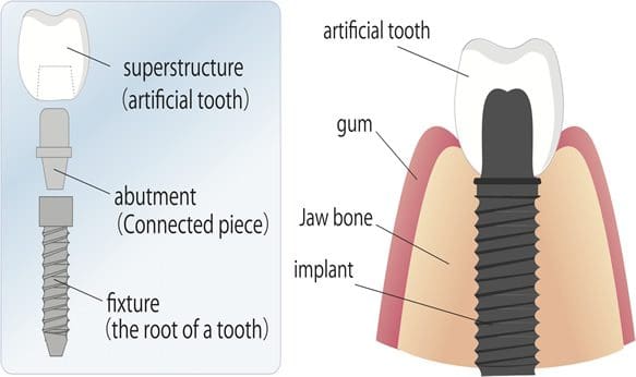 dental implant