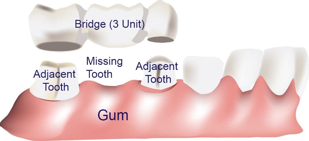 dental bridge