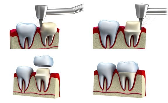 dental crown