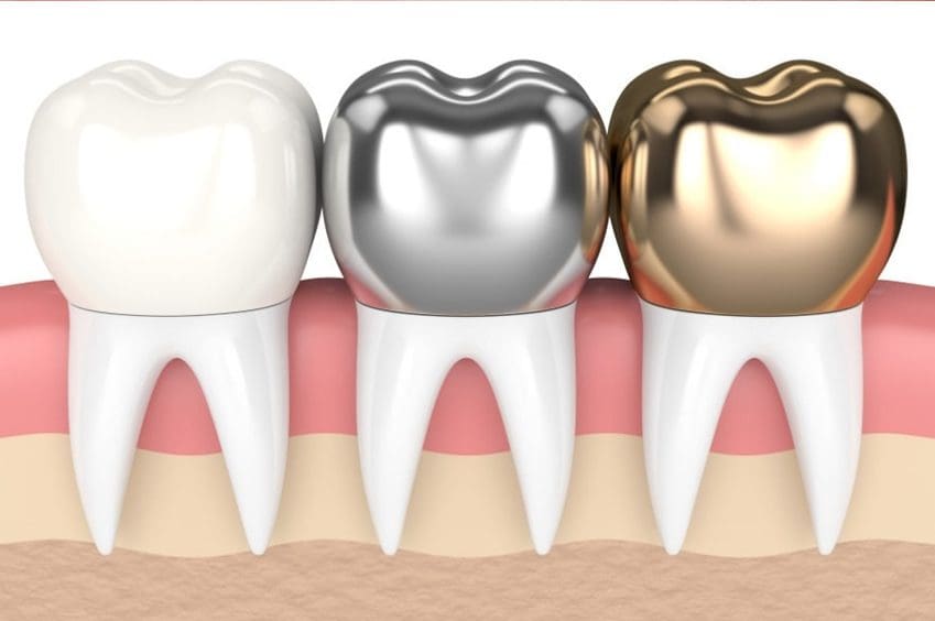 dental crowns