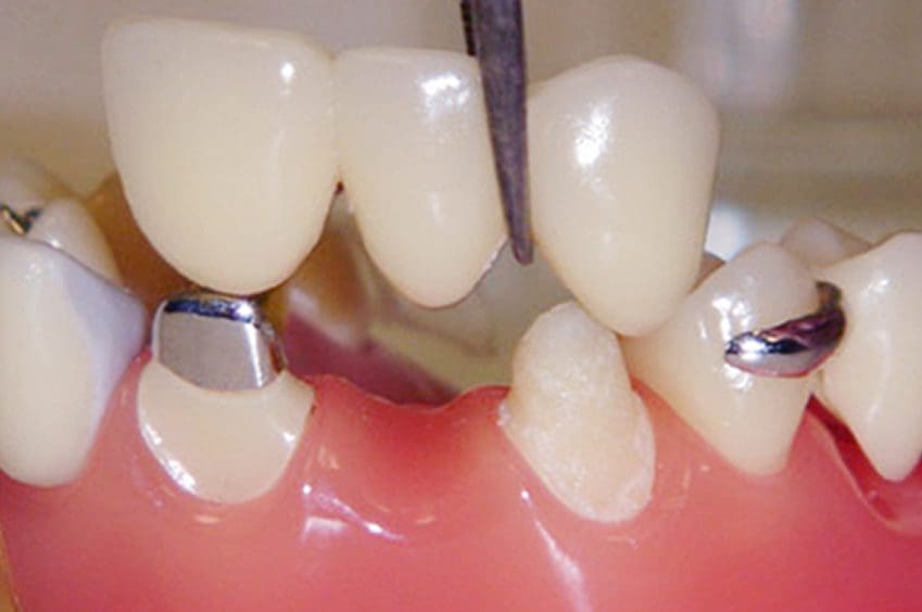 dental bridges