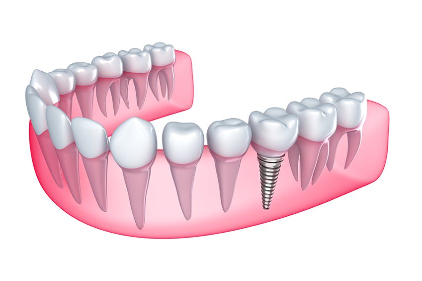 dential implants