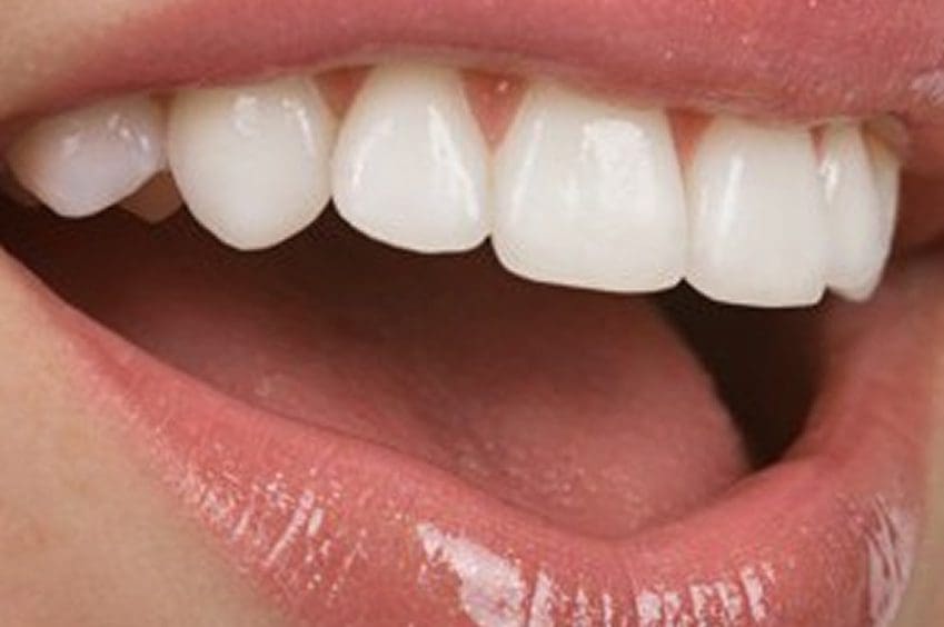 porcelain veneers