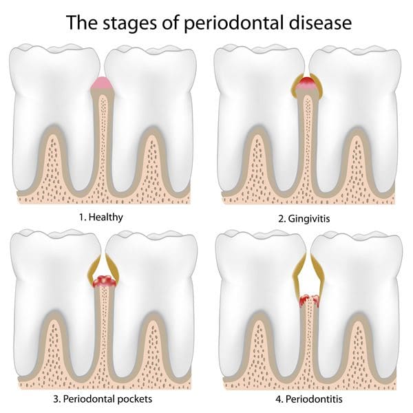 stages of periodontal disease