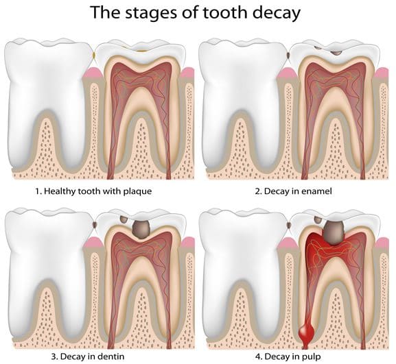 tooth decay