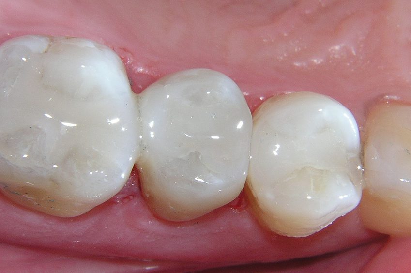 tooth colored fillings