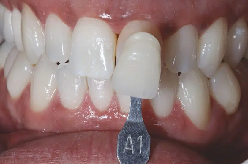 color matching teeth