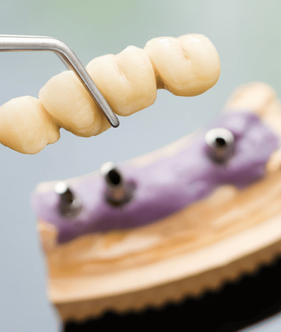 affordable dental bridge being displayed for patient education