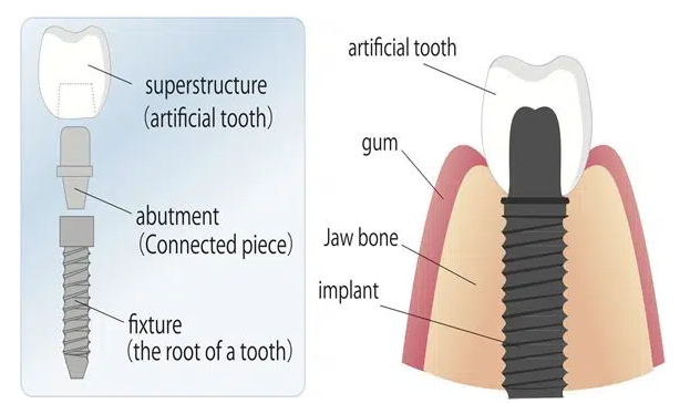 oceanside best dental implants