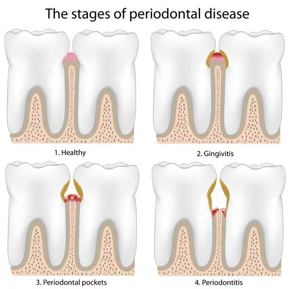 advanced gum disease