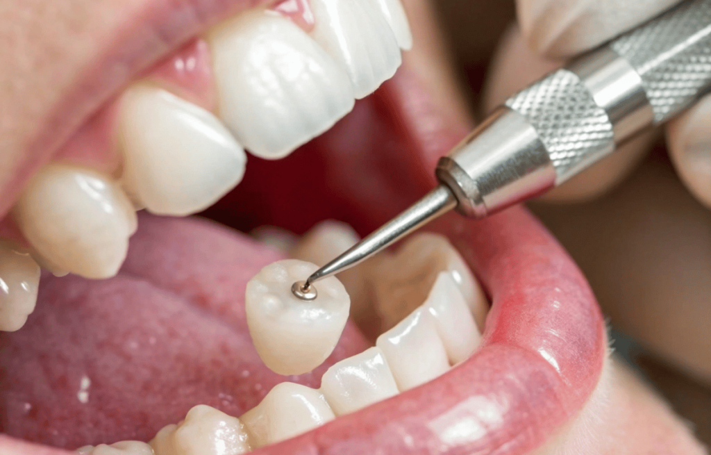 custom tooth colored fillings in oceanside