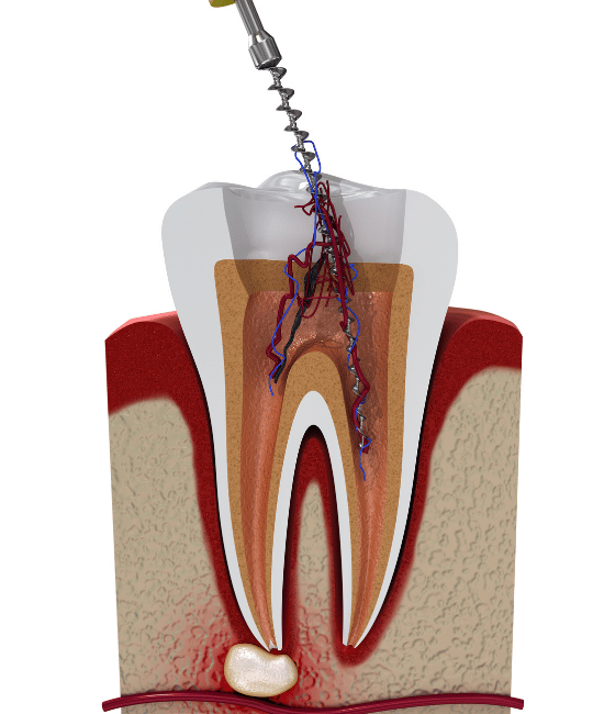 oceanside, ca root canal therpay illustration