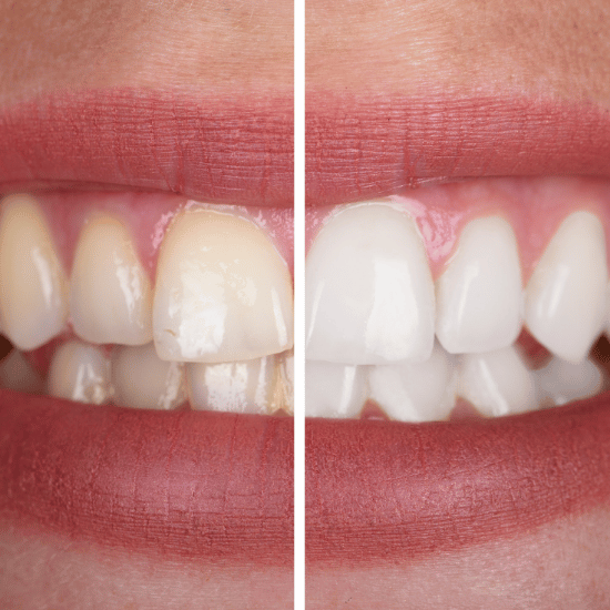 before and after teeth whitening