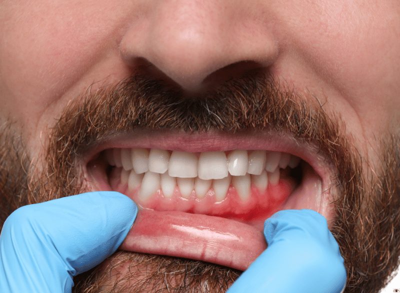 showing signs of irritated gums